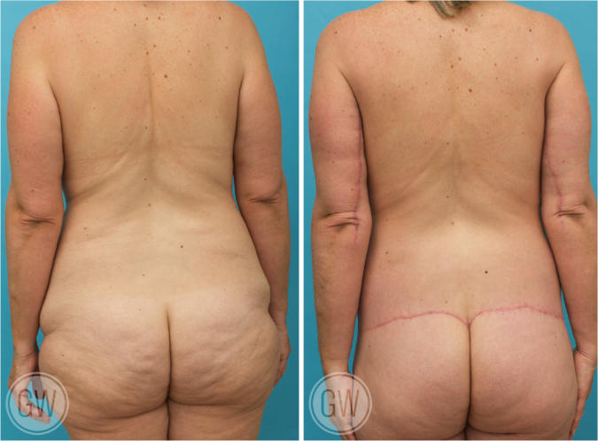 Total Body Lift - Lower Body Lift + Mons Pubis Lift + Thigh Lift + Arm Lift  + Breast Implants & Lift - Dr. Guy Watts