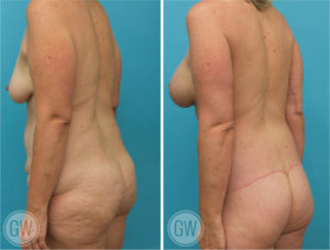 Total Body Lift - Lower Body Lift + Mons Pubis Lift + Thigh Lift + Arm Lift + Breast Implants & Lift