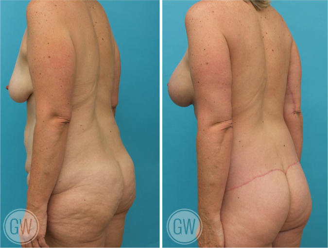 Mons Pubis - Liposuction Australia