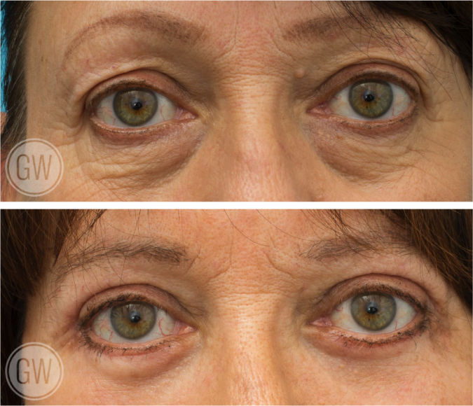 Upper and lower eyelid surgery