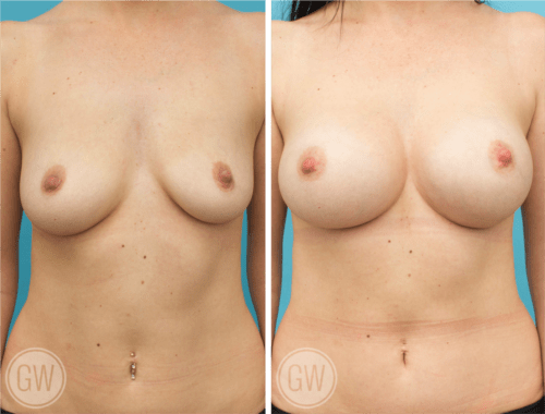 Asymmetrical breast implants - 375cc right 425 left dual plane round implants