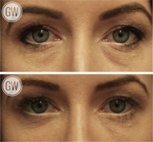 Lower Blepharoplasty - Transconjunctival