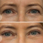 Upper eyelid surgery + brow lift