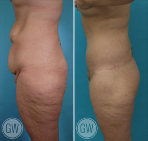 Abdominoplasty + Fleur De Lis + Mons lift + Lower Back Lift + Extended Thigh Lift