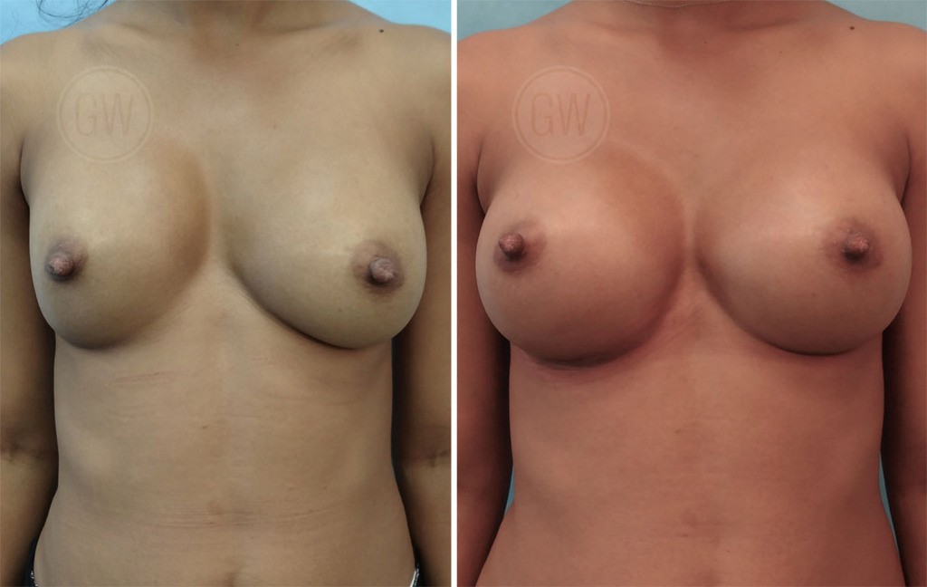 Breast Augmentation Revision