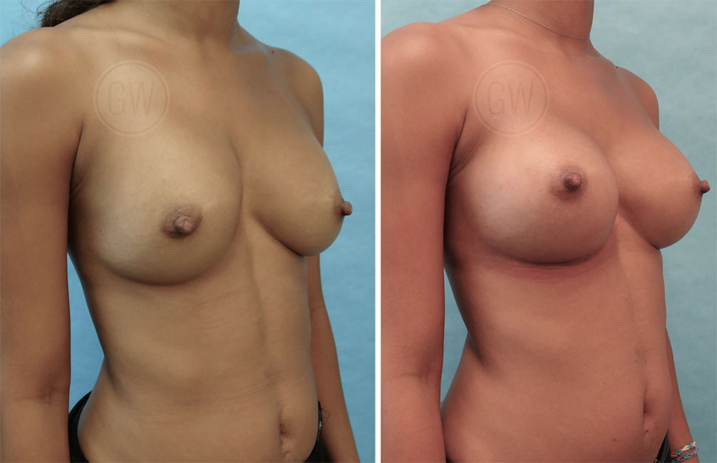 Breast Augmentation Revision