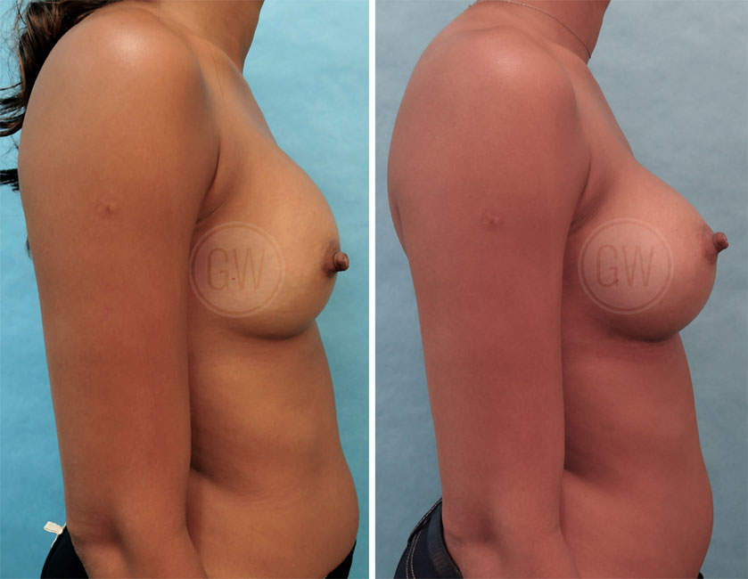 Breast Augmentation Revision