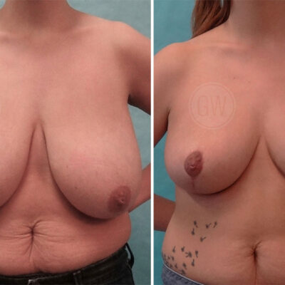 Breast Reduction Plastic Surgeon Perth - Breast Reduction