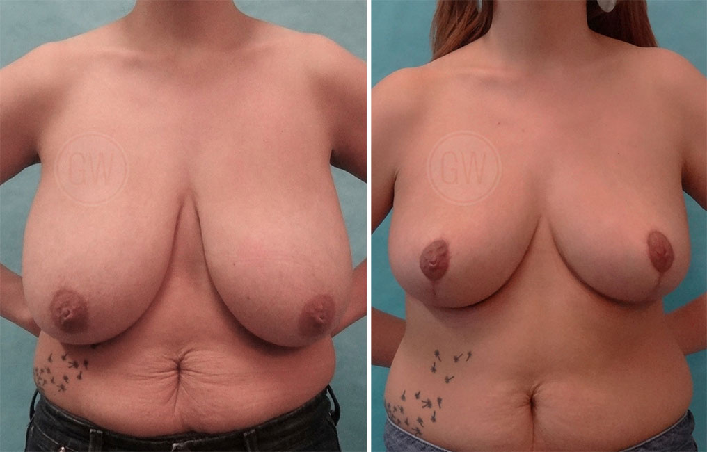 Plastic Surgeon Perth - Breast Reduction