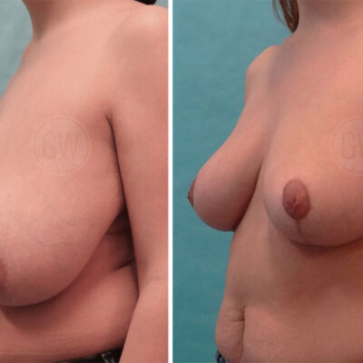Breast Reduction Breast Reduction