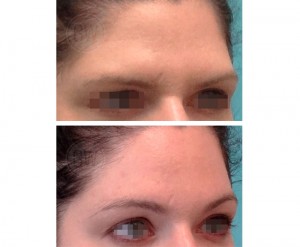 Endoscopic brow lift