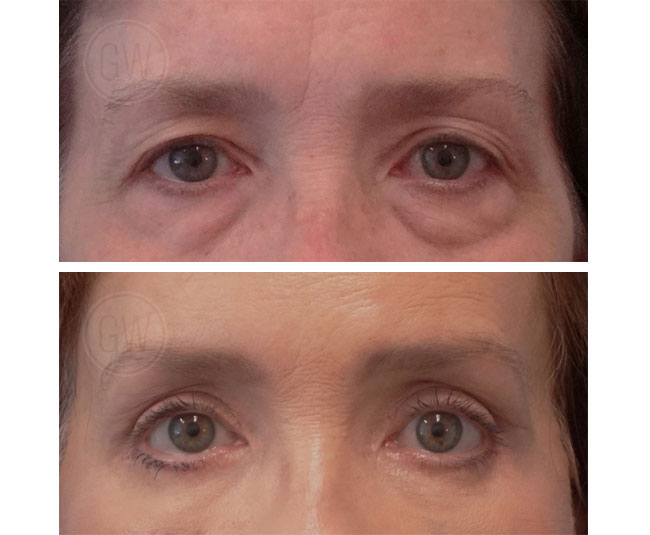 Endoscopic brow lift + upper and lower blepharoplasty