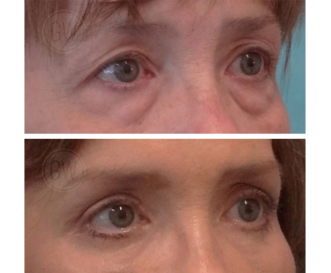 Endoscopic brow lift + upper and lower blepharoplasty