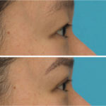 Asian eyelid surgery - Double eyelid