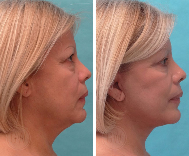 Facelift + neck lift + upper and lower blepharoplasty