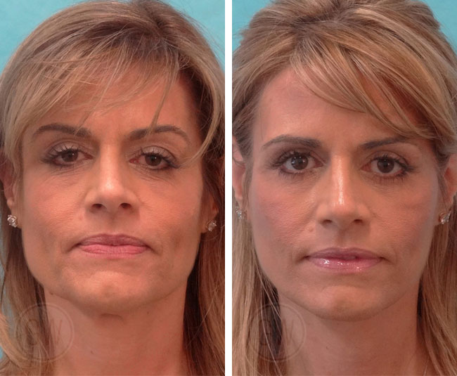 Face Lift Before and After Image-Patient with Long Hair