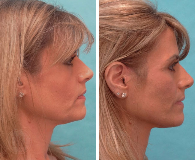 Mini facelift + neck lift + upper and lower blepharoplasty