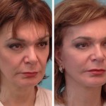 Revision facelift + neck lift + wrinkle relaxers