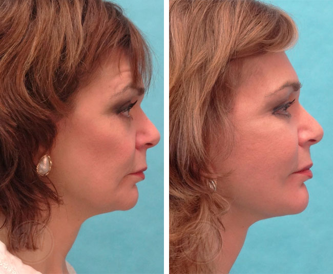 Revision facelift + neck lift + wrinkle relaxers