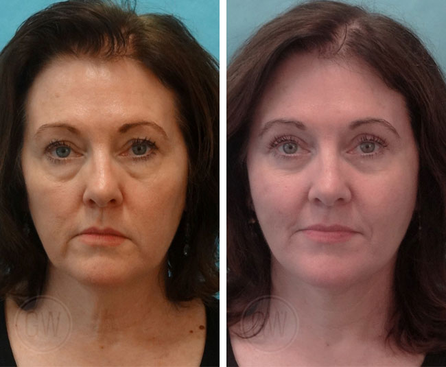 Face Lift Before and After Image - Patient with Natural Hair