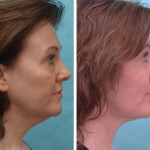 Facelift + neck lift + upper and lower blepharoplasty