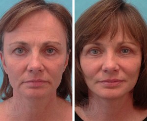 Facelift + neck lift + upper blepharoplasty + facial fat grafting + wrinkle relaxers