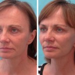 Facelift + neck lift + upper blepharoplasty + facial fat grafting + wrinkle relaxers