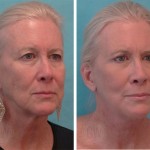 Facelift + anterior neck lift + upper blepharoplasty + facial resurfacing