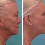 Facelift + anterior neck lift + upper blepharoplasty + facial resurfacing