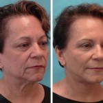 Facelift + anterior neck lift + upper blepharoplasty + wrinkle relaxers