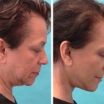 Facelift + anterior neck lift + upper blepharoplasty + wrinkle relaxers