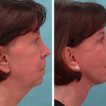 Facelift + anterior neck lift + upper blepharoplasty