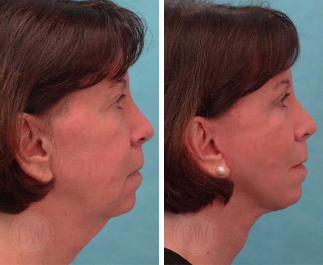 Facelift + anterior neck lift + upper blepharoplasty