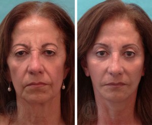 Facelift + neck lift + upper blepharoplasty + facial fat grafting + skin resurfacing + wrinkle relaxer