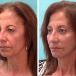 Facelift + neck lift + upper blepharoplasty + facial fat grafting + skin resurfacing + wrinkle relaxer