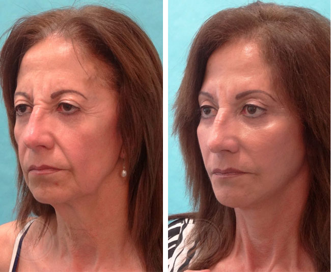 Facelift + neck lift + upper blepharoplasty + facial fat grafting + skin resurfacing + wrinkle relaxer