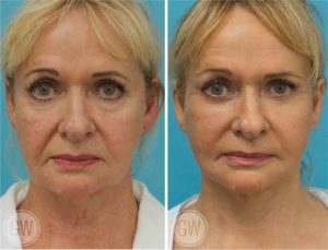 Facelift + necklift + upper and lower eyelid surgery + facial fat grafting + 35% TCA Peel + facelift results Perth