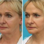 Facelift + necklift + upper and lower eyelid surgery + facial fat grafting + 35% TCA Peel
