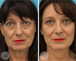 Rhinoplasty + facelift + neck lift + upper and lower eyelid surgery