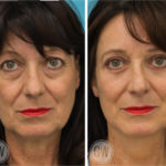 Rhinoplasty + facelift + neck lift + upper and lower eyelid surgery
