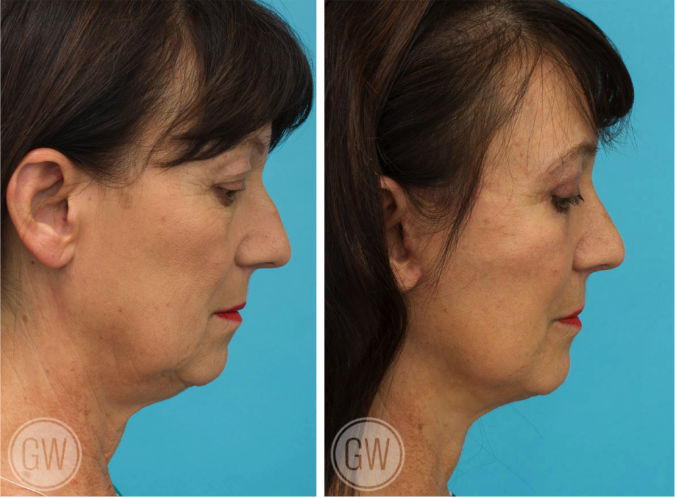 Facelift + neck lift + upper and lower eyelid surgery