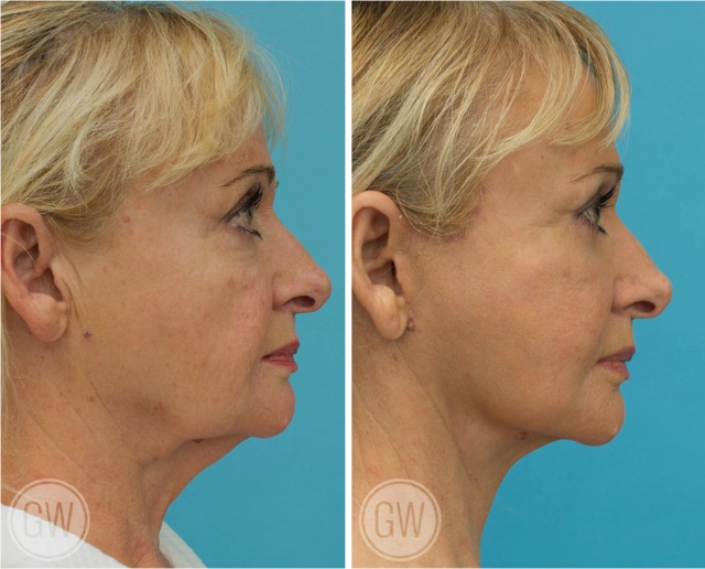 Facelift + necklift + upper and lower eyelid surgery + facial fat grafting + 35% TCA Peel