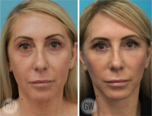 Facelift + Necklift + Upper + Lower Eyelid Surgery