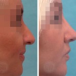 Rhinoplasty - Dorsal hump reduction + Nasal tip elevation