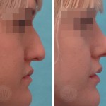Rhinoplasty - Dorsal Hump Reduction + Nasal Tip Elevation