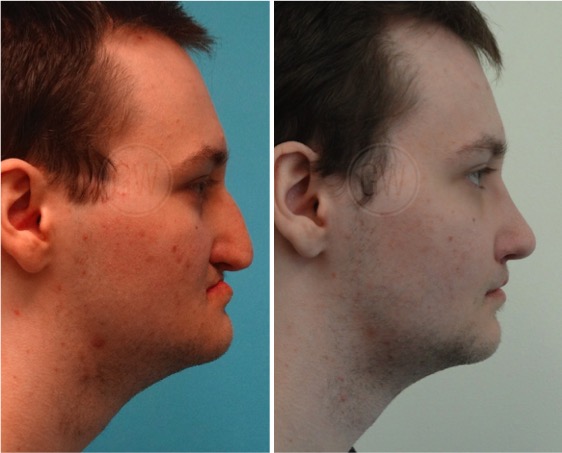 Rhinoplasty + Septoplasty + prirform augmentation + upper lip fat grafting
