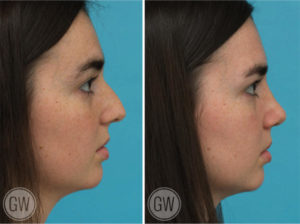 Rhinoplasty + Septoplasty + Turbinate reduction