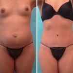 Plastic Surgeon Perth - Tummy Tuck Abdominoplasty
