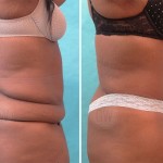 Plastic Surgeon Perth - Tummy Tuck Abdominoplasty plus Liposuction