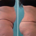 Plastic Surgeon Perth - Tummy Tuck Abdominoplasty plus Liposuction